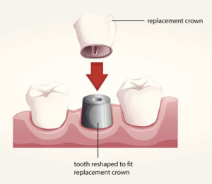 Diagram of a dental crown being placed on a dental implant used by Tulsa dentist.