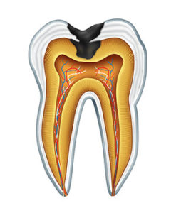 Illustration of a tooth with decay from a cavity used by Tulsa dentist at T-Town Smiles.