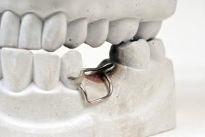 Orthodontic Space Maintainer in a fake jaw used by Tulsa dentist at T-Town Smiles.