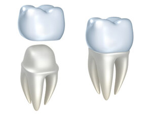 Illustration of dental crowns placed on teeth.
