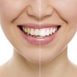 Clear Drinks Can Still Stain Your Teeth