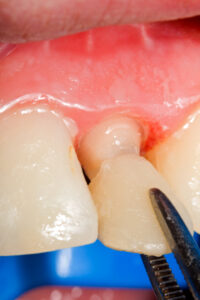 What To Do If You Notice Your Dental Veneer Starting To Come Off